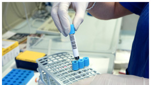 La gravit&agrave; dell'Alzheimer stimata da un semplice test del sangue