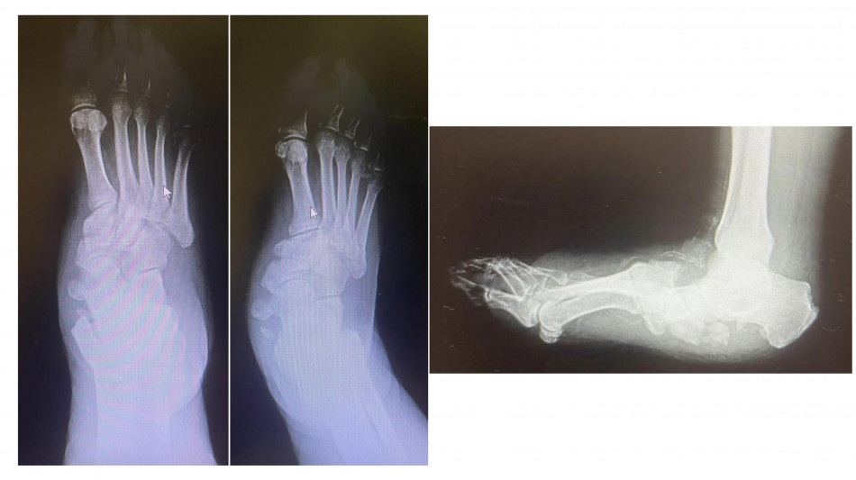 Diabete, al Gemelli soluzioni avanzate per il piede di Charcot